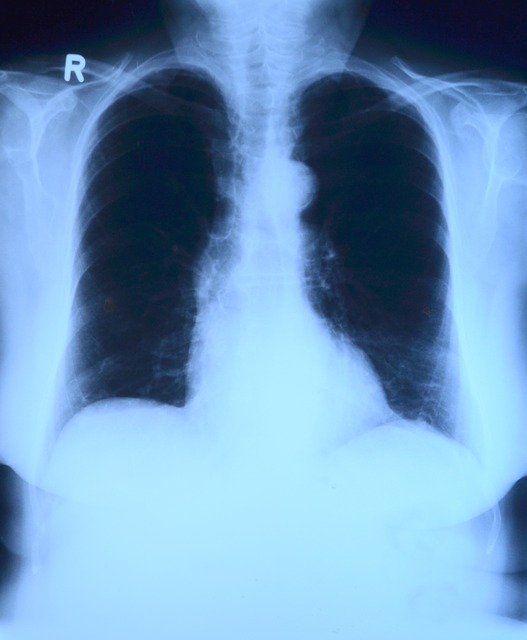 Otkrivena nova vrsta raka pluća i nema veze s pušenjem