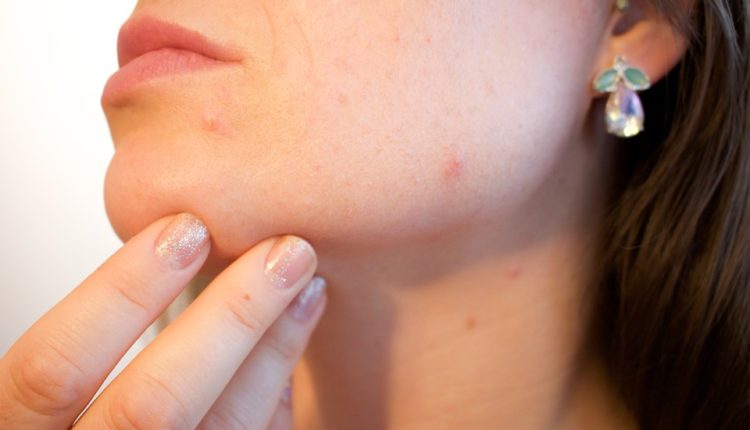 Male boginje u Srbiji i Evropi: kakve su prognoze? Male boginje u Srbiji i Evropi: kakve su prognoze?