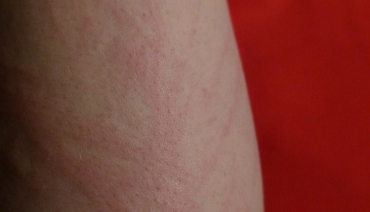 Epidemija malih boginja u Srbiji prolazi ili? Epidemija malih boginja u Srbiji prolazi ili?