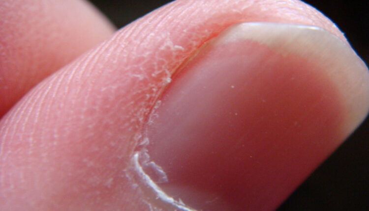 Boja noktiju otkriva kakvo je vaše zdravstveno stanje