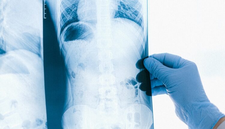 7 simptoma opake bolesti od koje je preminuo Žarko Laušević: Napreduje tako brzo da nema vremena ni da se primi terapija 7 simptoma opake bolesti od koje je preminuo Žarko Laušević: Napreduje tako brzo da nema vremena ni da se primi terapija