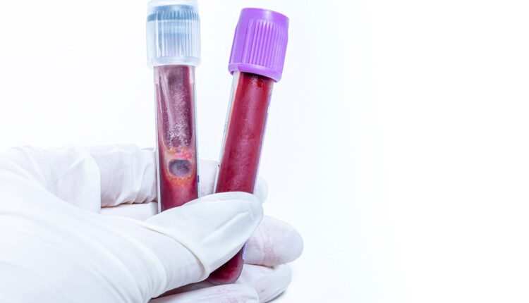 Krvna grupa koja najduže živi: Ubedljivo je najotpornija na opasne bolesti