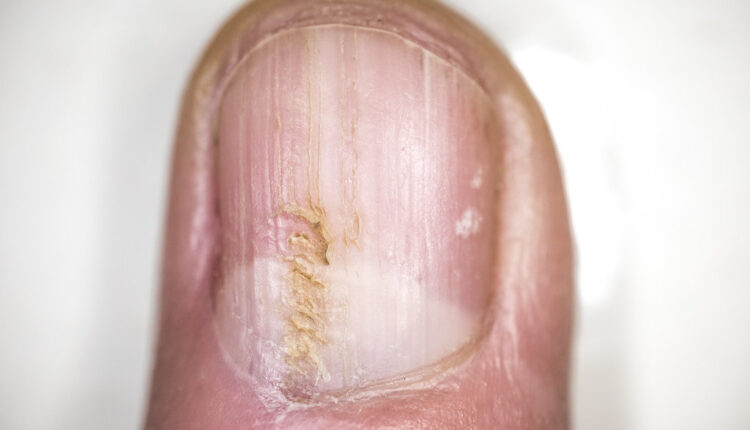 Najbolje rešenje za gljivice na noktima: Jedan sastojak uništava infekciju