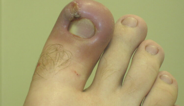 Nokti na nogama su slika zdravlja: Ako uočite ovu boju na njima, hitno se javite lekaru – može da bude znak veoma opasne bolesti